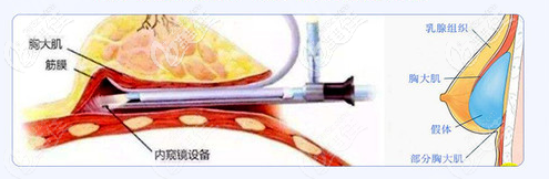 珠海九龙医院内窥镜+双平面隆胸技术