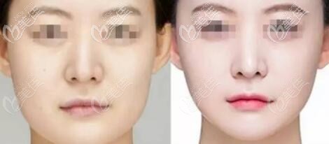 下颌角削骨截骨术前术后对比照