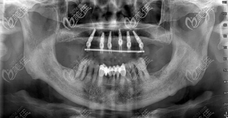 种植牙后的CT照