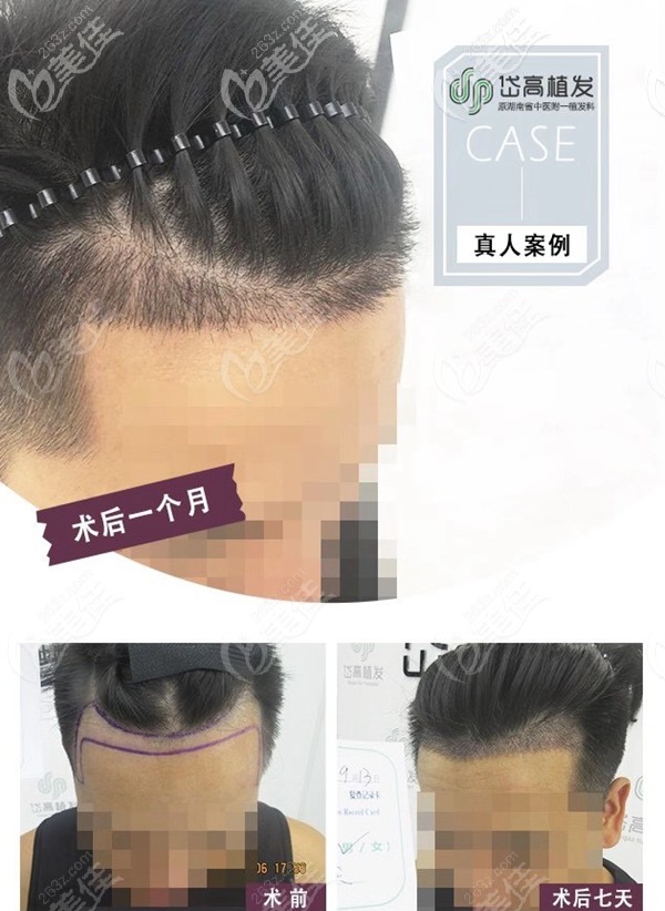 岱高前额发际线种植案例