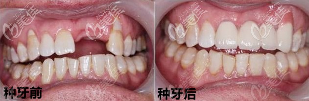 20210422_1619079558106021.jpg 福州维乐种牙案例_副本.jpg