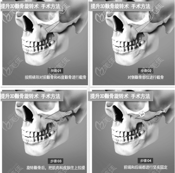 3D颧骨旋转术的手术图解
