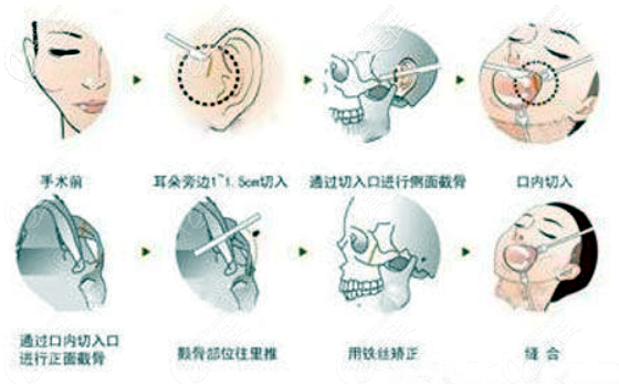 颧骨内推的手术图解