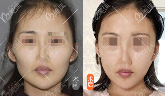 3d颧骨旋转截骨手术效果图