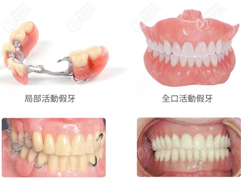 固定义齿和活动义齿的区别
