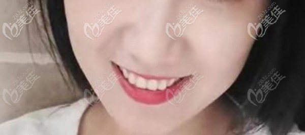 正畸后的我自信了