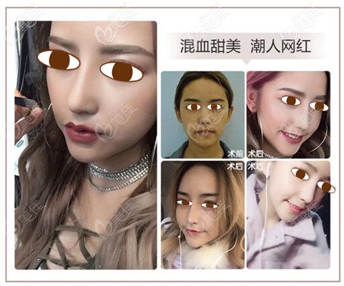 鼻小柱、鼻翼宽大修复案例