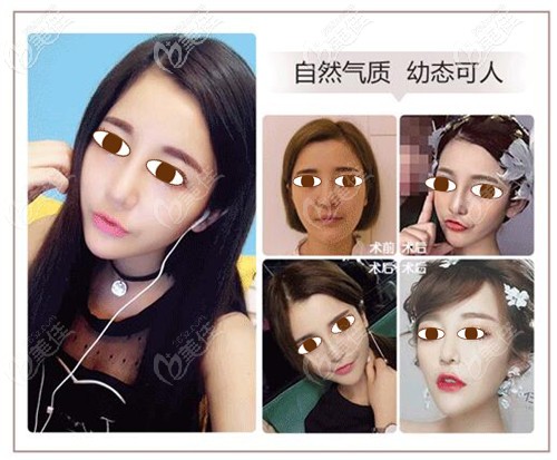 低鼻梁修复案例