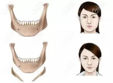 下颌角削骨前后效果