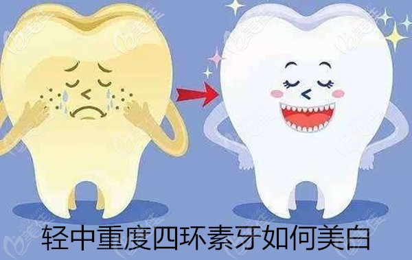 轻中重度四环素牙如何美白 轻中重度四环素牙如何美白