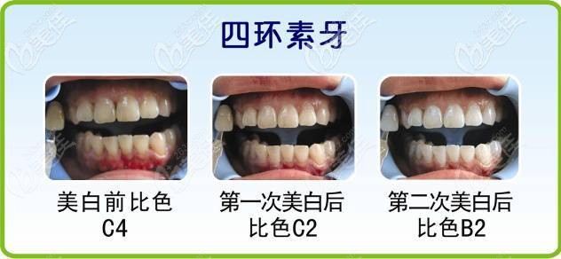 四环素牙美白前后对比图 四环素牙美白前后对比图