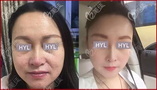 韩艺来整形拉皮案例