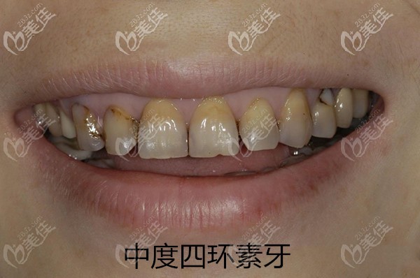 中度四环素牙 中度四环素牙