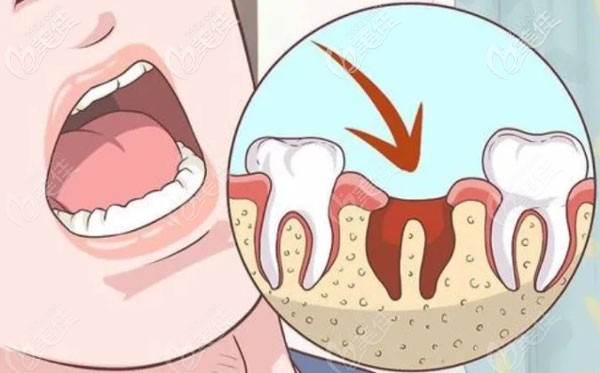 宁波的拔牙收费价格