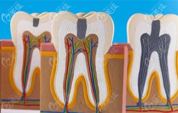 牙冠的收费标准