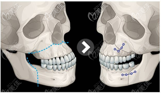 广东美恩王友元医生做正颌手术怎么样 广东美恩王友元医生做正颌手术怎么样