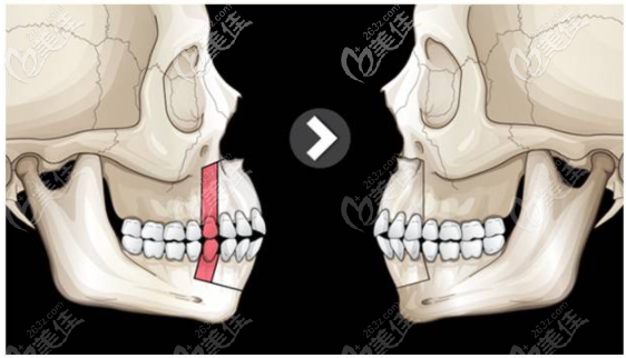 王友元正颌技术优势及方法 王友元正颌技术优势及方法