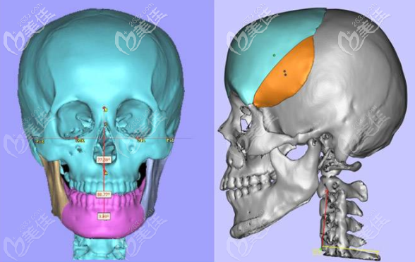 广东美恩王友元3d数字化正颌技术优势 广东美恩王友元3d数字化正颌技术优势