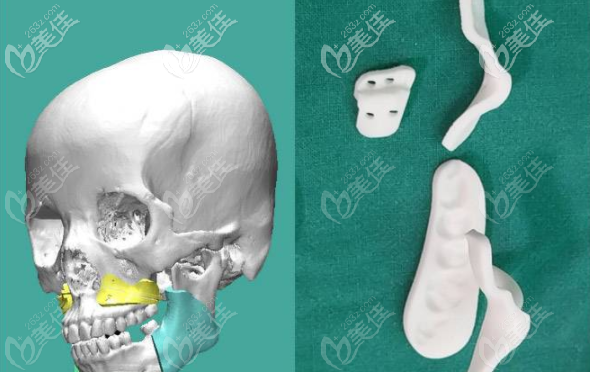 广州美恩王友元3D正颌导板 广州美恩王友元3D正颌导板