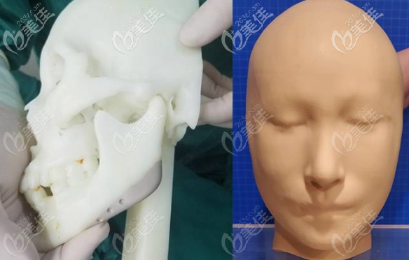 广州美恩王友元3d定制技术修复骨缺损 广州美恩王友元3d定制技术修复骨缺损