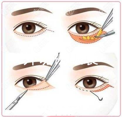 眼周提升手术切口 眼周提升手术切口
