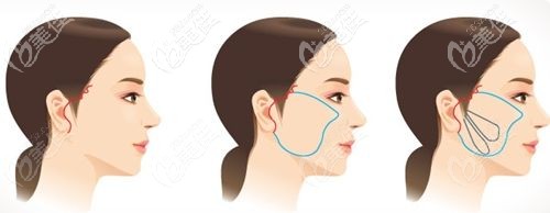 拉皮手术剥离范围 拉皮手术剥离范围