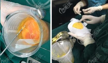 5G维密脂雕吸出的脂肪