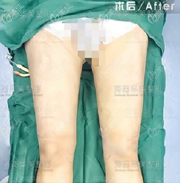 来看海南华美5G维密脂雕吸脂瘦大腿真人前后对比高清照片，效果好不好很明显！