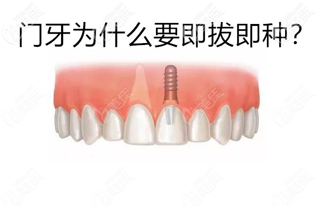 门牙为什么要即拔即种 门牙为什么要即拔即种