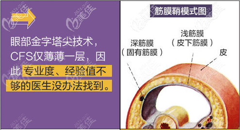 CFS联合筋膜鞘眼修复技术