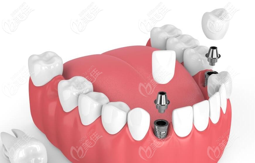 即刻种植适用条件 即刻种植适用条件