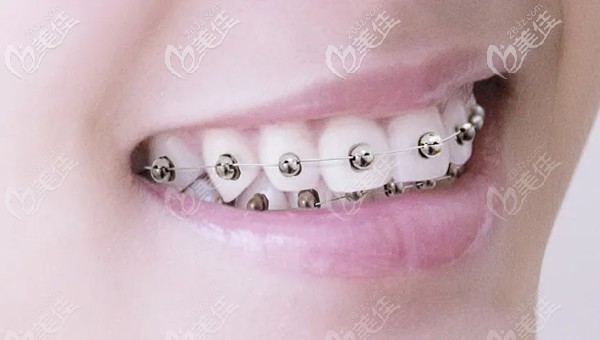 obrace球面自锁托槽矫正好不好