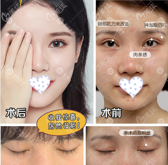 李富强双眼皮修复案例