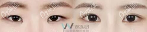 开内眼角前后对比照 开内眼角前后对比照