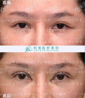 几组北京潘彦龙医生做的修复内眼角案例反馈:他修复技术还不错