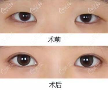 双眼皮开内眼角真人前后对比照 双眼皮开内眼角真人前后对比照