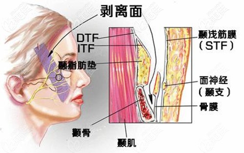 筋膜悬吊和筋膜提升的区别