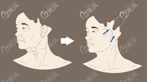 筋膜悬吊切除改善问题