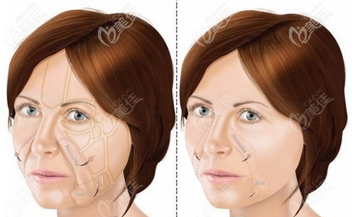 面部拉皮手术筋膜折叠和筋膜悬吊的区别