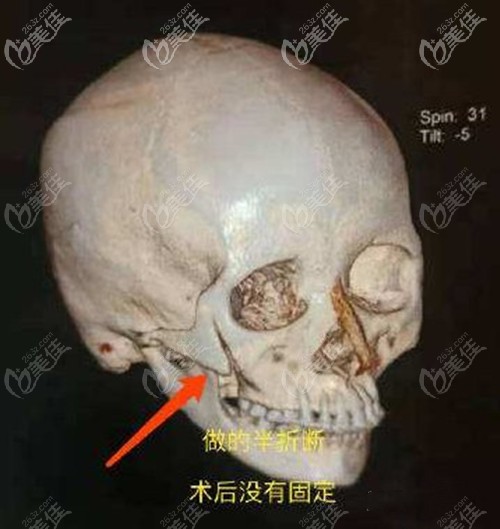 颧骨半折断不固定的原理