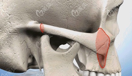 颧骨双向折断原理