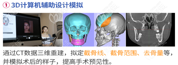 广州广大何锦泉做正颌手术可以精细到0.1MM
