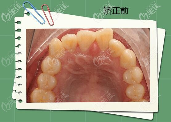 北京精德口腔牙齿拥挤矫正案例 北京精德口腔牙齿拥挤矫正案例
