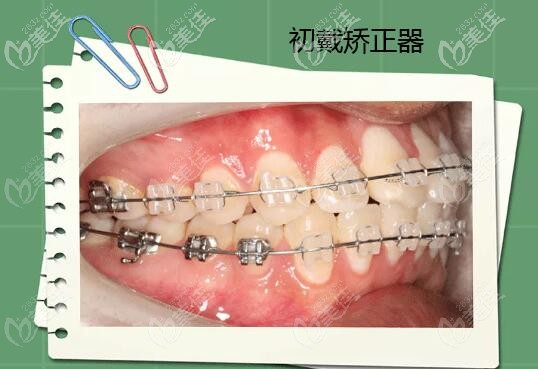 牙齿中度拥挤+前突初戴牙套 牙齿中度拥挤+前突初戴牙套