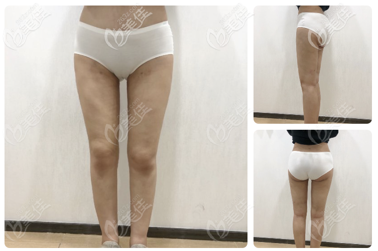 看深圳曹孟君做的土麦森大腿吸脂术后效果怎么样 看深圳曹孟君做的土麦森大腿吸脂术后效果怎么样