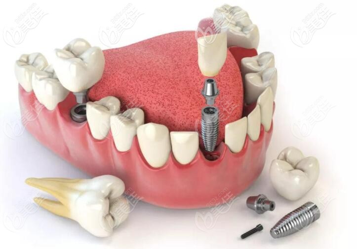 种植牙的结构分布