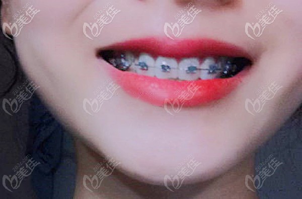 自锁托槽矫正地包天 自锁托槽矫正地包天