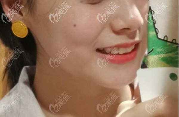 爆照！戴国产自锁托槽正畸牙套矫正假性地包天小姐姐的漂亮反击