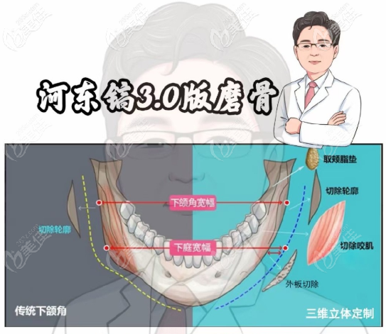 河式3.0微创磨骨术式