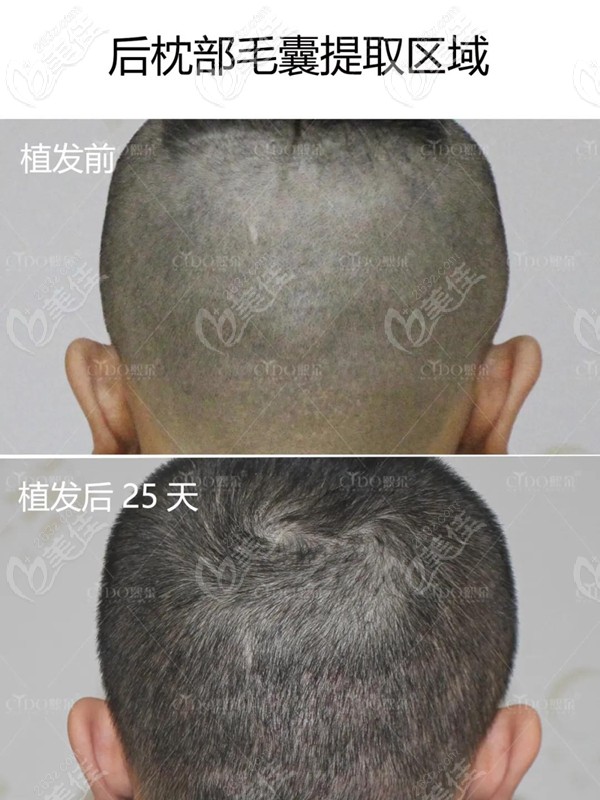 熙朵植发后后枕部恢复情况 熙朵植发后后枕部恢复情况